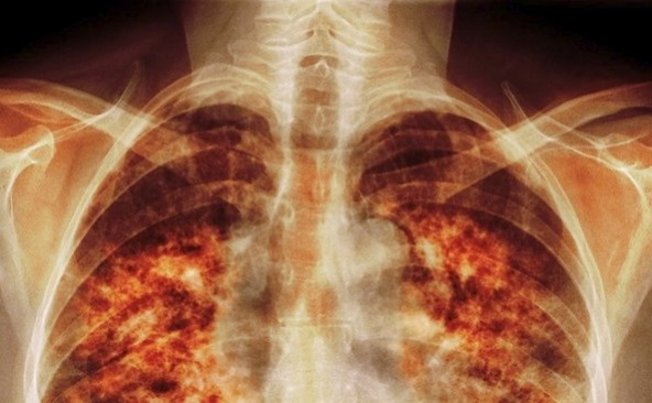 Obrázek epizody 60% lidí, kteří trpí idiopatickou plicní fibrózou jsou kuřáci, říká lékař Ladislav Lacina