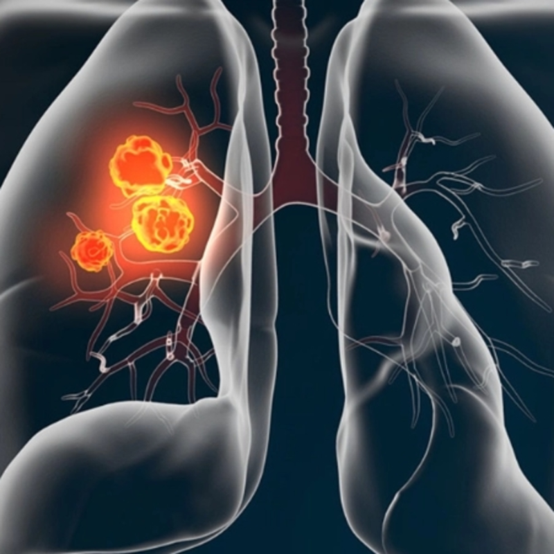 Obrázek epizody Profesorka Martina Koziar Vašáková: Rakovina plic často nebolí. Český screening ji ale umí odhalit včas