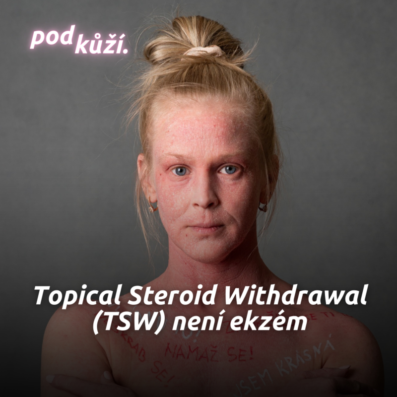 Obrázek epizody Janča: Topical Steroid Withdrawal (TSW) není ekzém. Přála bych si, aby to lékaři pochopili