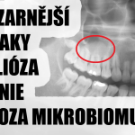 Obrázek epizody Bolesti zubů, křeče, bolavé žíly, bolavá erekce, alergie. Nejbizarnější příznaky. Borelioza yersinie