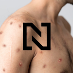 Obrázek epizody Co byste měli vědět o opičích neštovicích