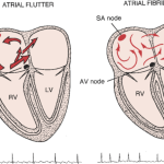 Obrázek epizody (KardioPodcast #9) Flutter versus Fibrilace