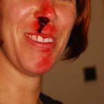 Obrázek epizody Mýty o první pomoci: Při krvácení z nosu zaklonit hlavu? (Veronika Cingelová, PrPom)